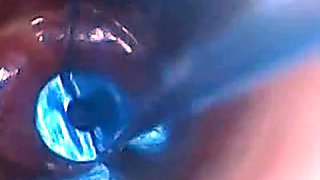Endoscope POV: Test Tube Cock Urethral Insertion
